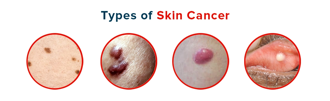 Types of Skin Cancer